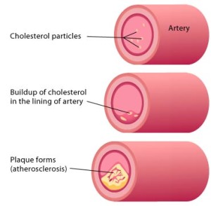what does atorvastatin do to your body