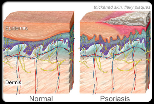 psoriasis skin disease called
