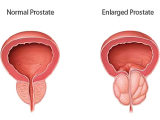 Prostate Gland Enlargement: How It Affects Your Life and How You Can Treat It