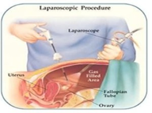 Endometriosis-TrueMedCost