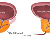 Benign Prostate Hyperplasia